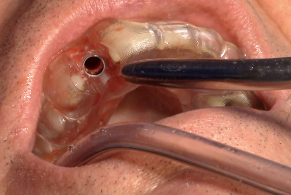 certficate in dental implants London